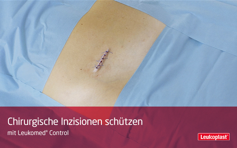 Dieses Video zeigt, wie chirurgische Inzisionen während des Heilungsprozesses geschützt werden können: Das Fachpersonal deckt den Schnitt mit Leukomed® Control ab. Dieses Video zeigt, wie chirurgische Inzisionen während des Heilungsprozesses geschützt werden können: Das Fachpersonal deckt den Schnitt mit Leukomed® Control ab.